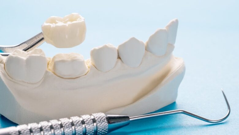 Dental Crowns: Luxurious Solutions For Perfect Smiles  