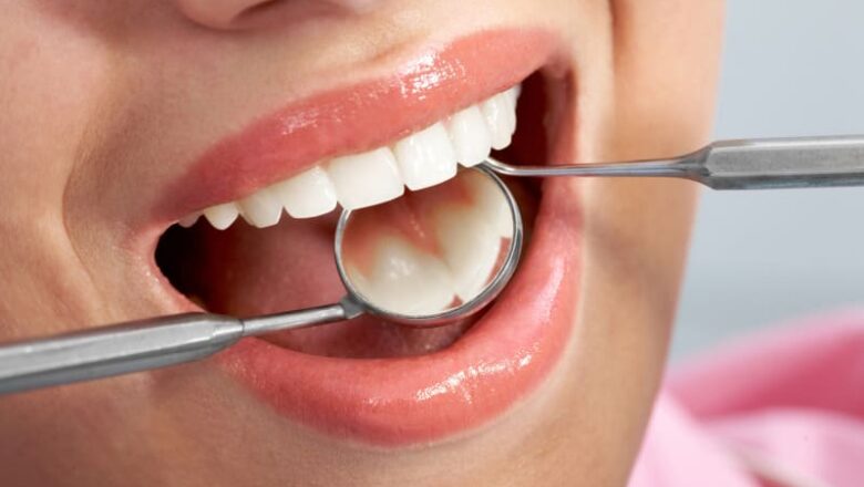 The Beauty of Composite Fillings: A Closer Look