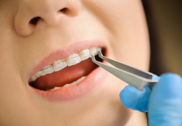 Is it time to see an orthodontist in Irving? Check more here