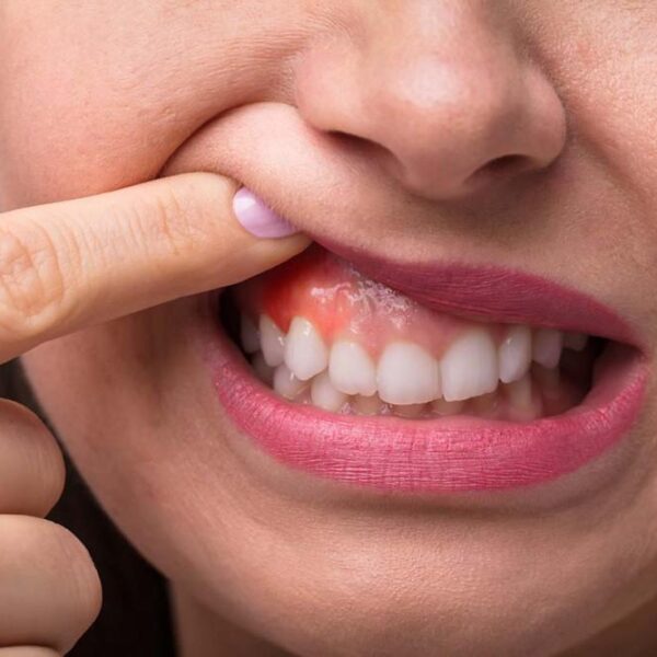 How to Handle a Swollen Gum Emergency 