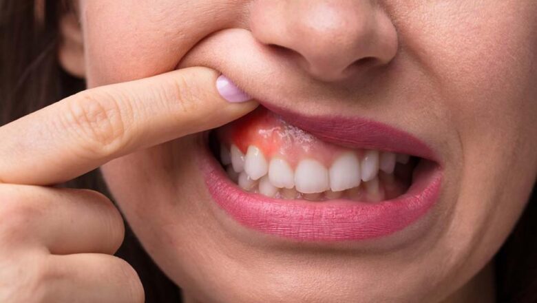 How to Handle a Swollen Gum Emergency 
