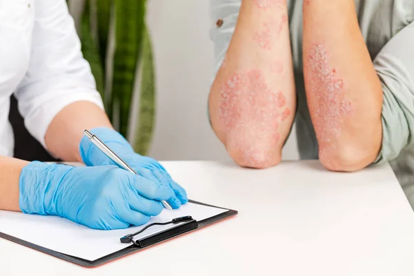 Psoriasis Treatment